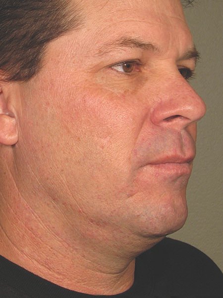 Ultherapy face before