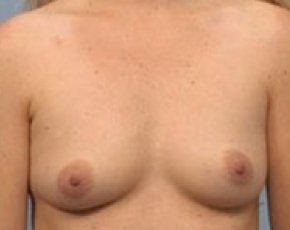 Breast Augmentation Before & After Gallery - Patient 5883069 - Image 1