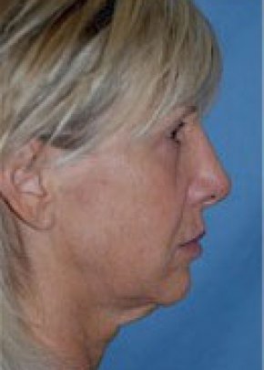 Facelift and Mini Facelift Before & After Gallery - Patient 5883732 - Image 1