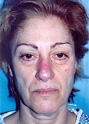 Plastic surgery patient at Allure Plastic Surgery