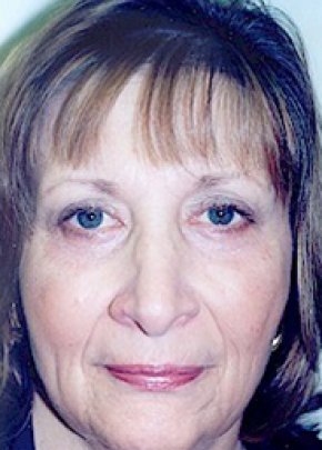 Eyelid Surgery Browlift Before & After Gallery - Patient 5883743 - Image 2