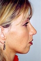Plastic surgery patient at Allure Plastic Surgery
