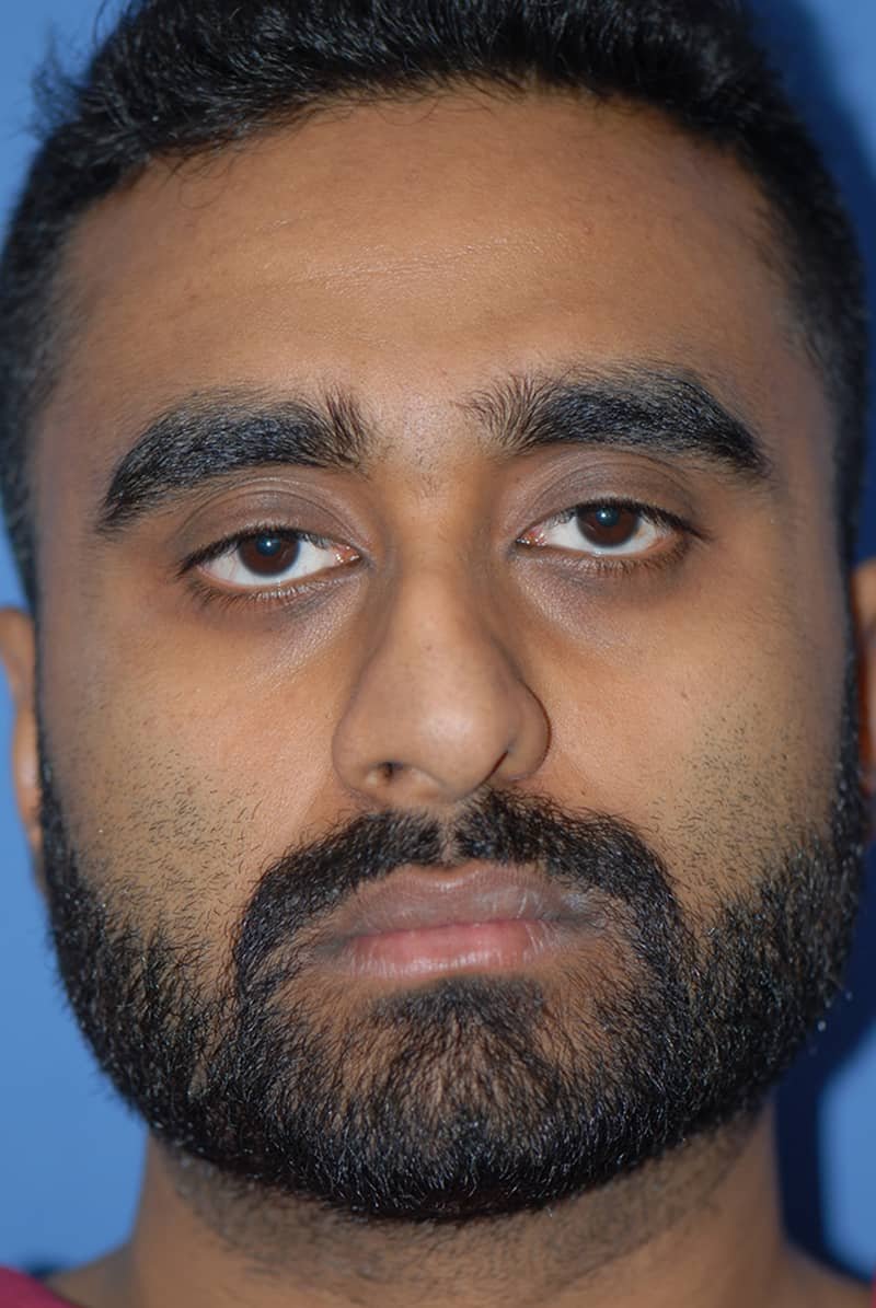 Rhinoplasty Before & After Gallery - Patient 5883824 - Image 1