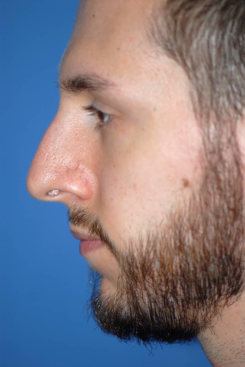 Plastic surgery patient at Allure Plastic Surgery