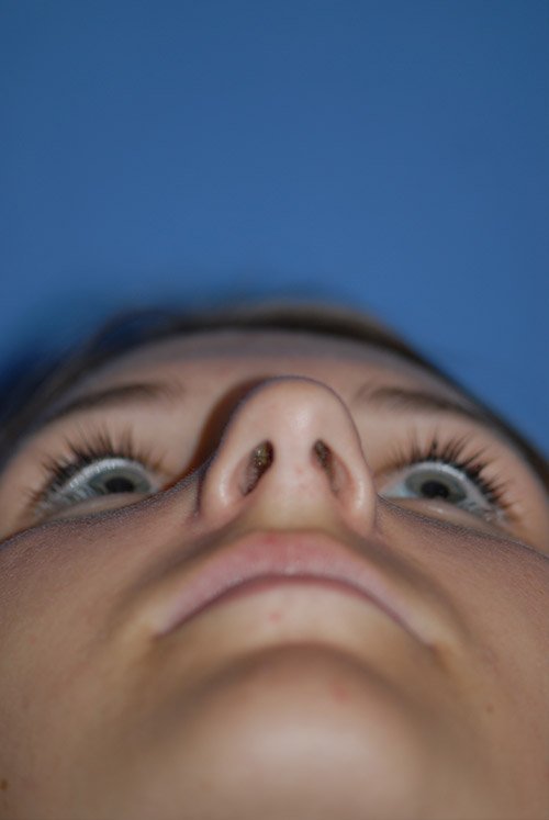 Rhinoplasty Before & After Gallery - Patient 5883835 - Image 7