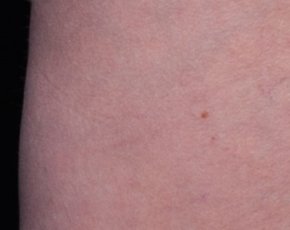 Cellfina Before & After Gallery - Patient 5883987 - Image 2