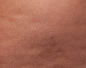 Cellfina Before & After Gallery - Patient 5883995 - Image 2