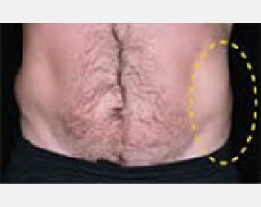 CoolSculpting Before & After Gallery - Patient 5884034 - Image 2