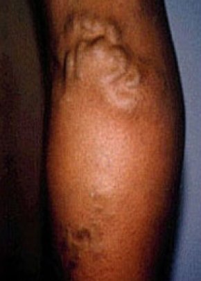 Spider Vein Removal Before & After Gallery - Patient 5884042 - Image 1