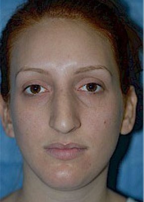 Rhinoplasty Before & After Gallery - Patient 5884054 - Image 1