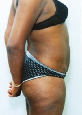 Liposuction and Smartlipo Before & After Gallery - Patient 5946651 - Image 2