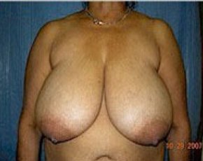 Plastic surgery patient at Allure Plastic Surgery