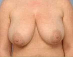 Breast Lift and Reduction Before & After Gallery - Patient 5951176 - Image 1