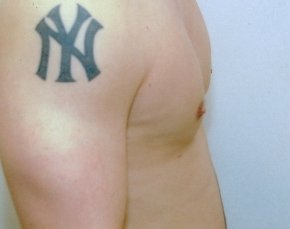 Male Breast Reduction Before & After Gallery - Patient 5951698 - Image 2