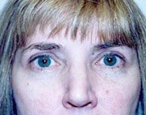 Eyelid Surgery Browlift Before & After Gallery - Patient 5952226 - Image 2