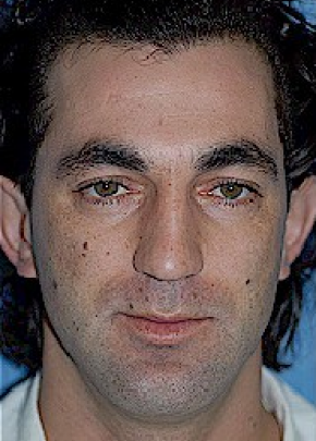 Rhinoplasty Before & After Gallery - Patient 5952230 - Image 1