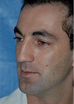 Rhinoplasty Before & After Gallery - Patient 5952230 - Image 3